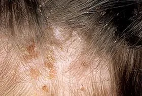 picture of head lice