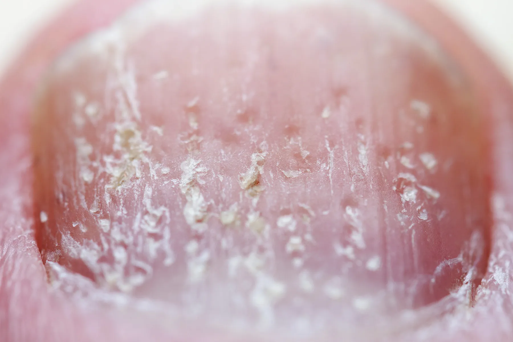 photo of nail psoriasis