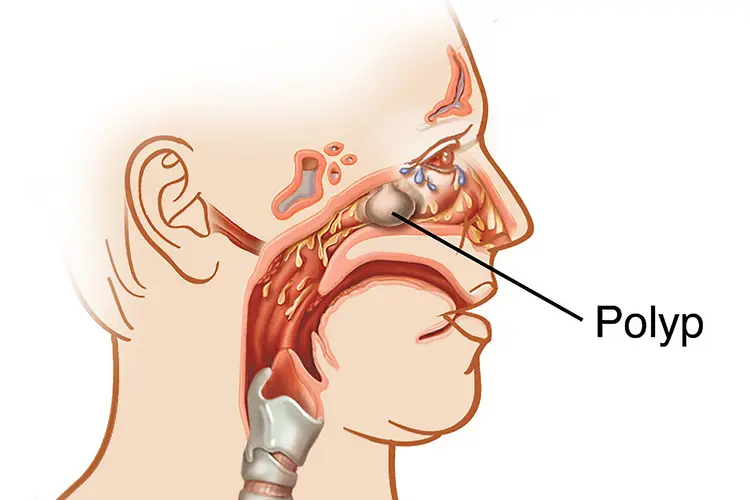 illustration of nasal polyp