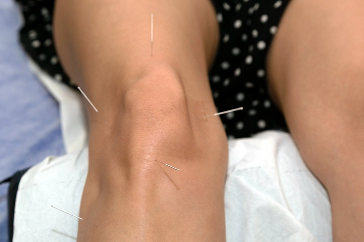 Acupoint: Arthritis Pain Acupoint: Arthritis Pain