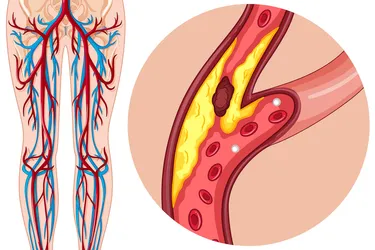 photo of pad illustration