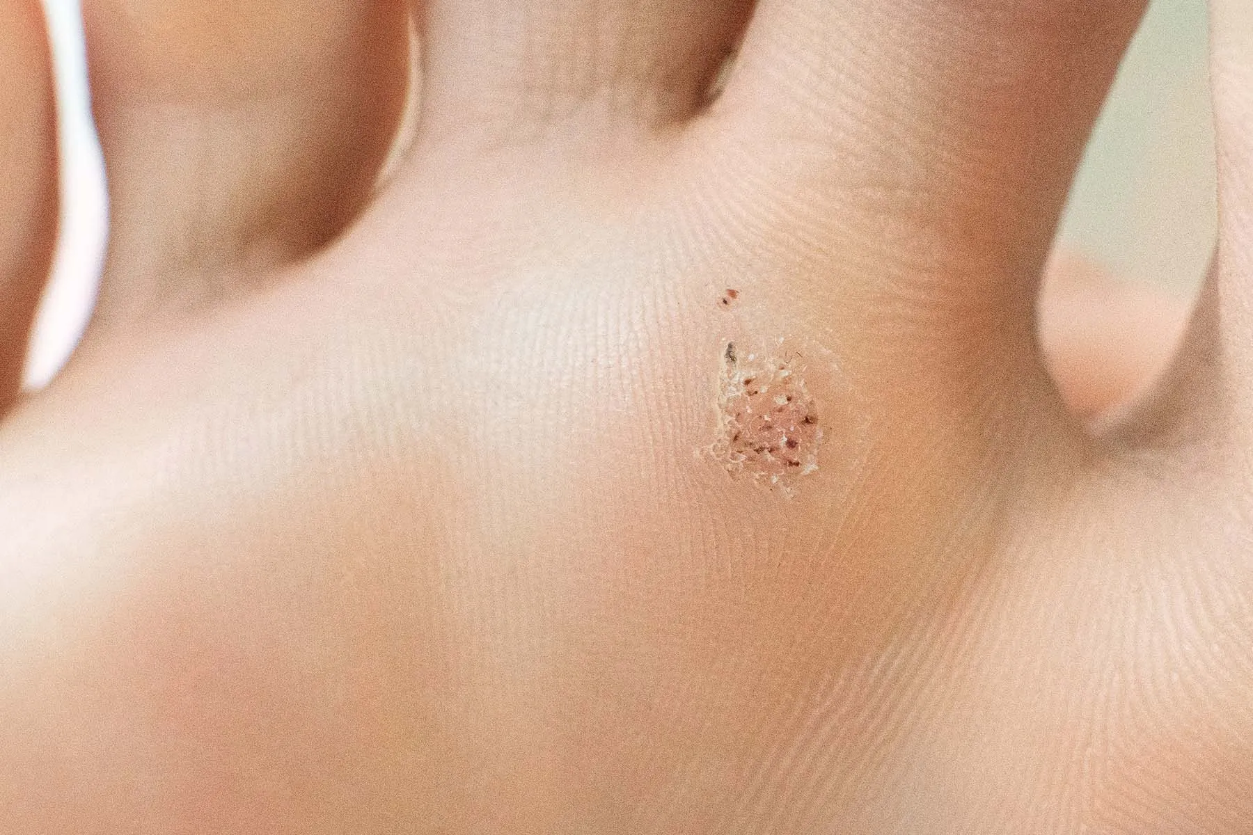 photo of plantar wart