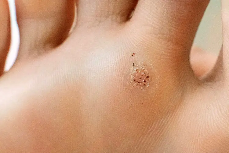 photo of plantar wart