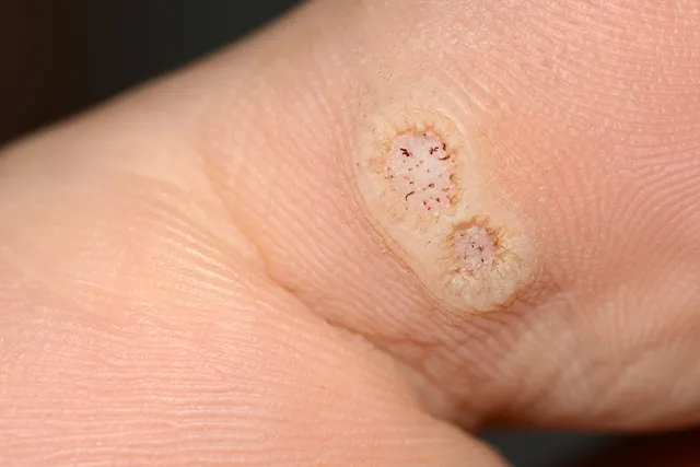 What to Know About Plantar Warts