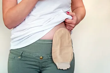 After ostomy surgery, a bag connects to a hole in your stomach and collects pee and poop. (Photo Credit: matuska/Pond5)