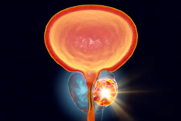 Prostate Cancer Treatment 