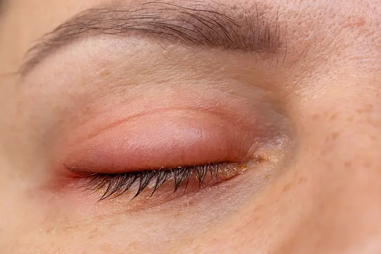 photo of swollen eyelid