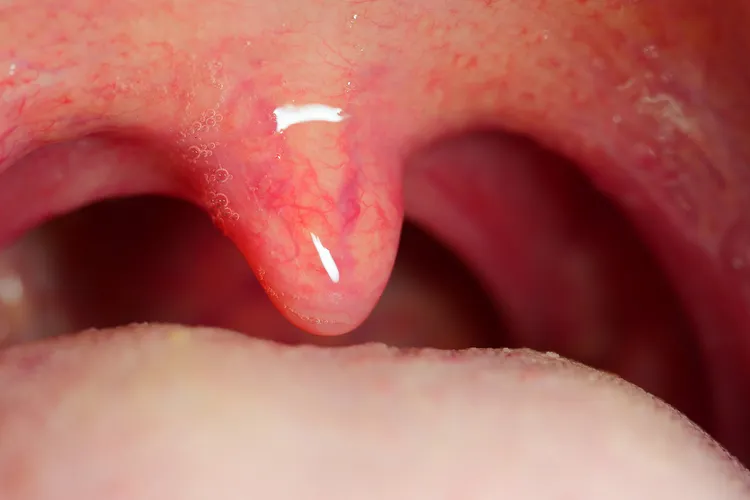 photo of uvula