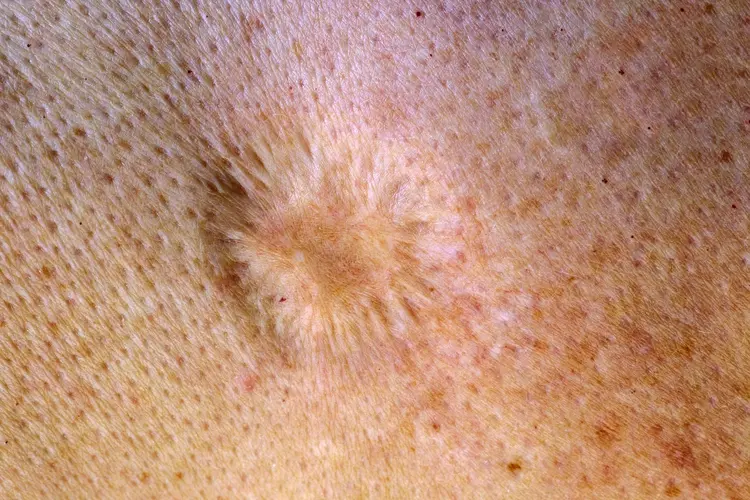 photo of vaccination scar