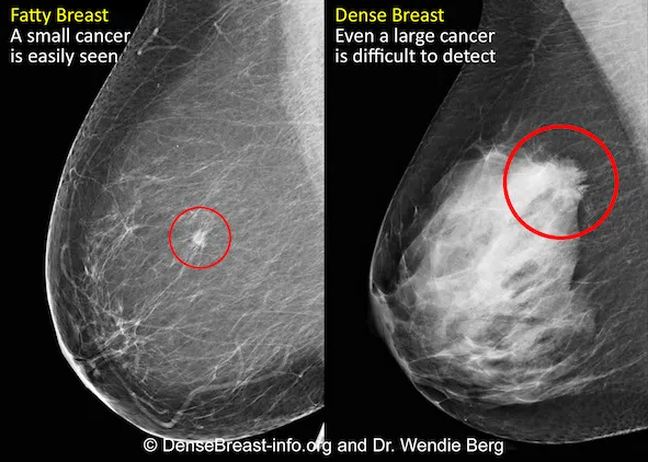 fatty vs dense breast imaging