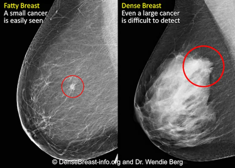 fatty vs dense breast imaging