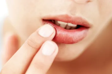 Chapped lips or cheilitis happens when your lips feel dry and cracked. Many things can cause chapped lips, including weather, lack of certain nutrients in your diet, and allergic reactions. (Photo credit: Stockbyte/Getty Images)