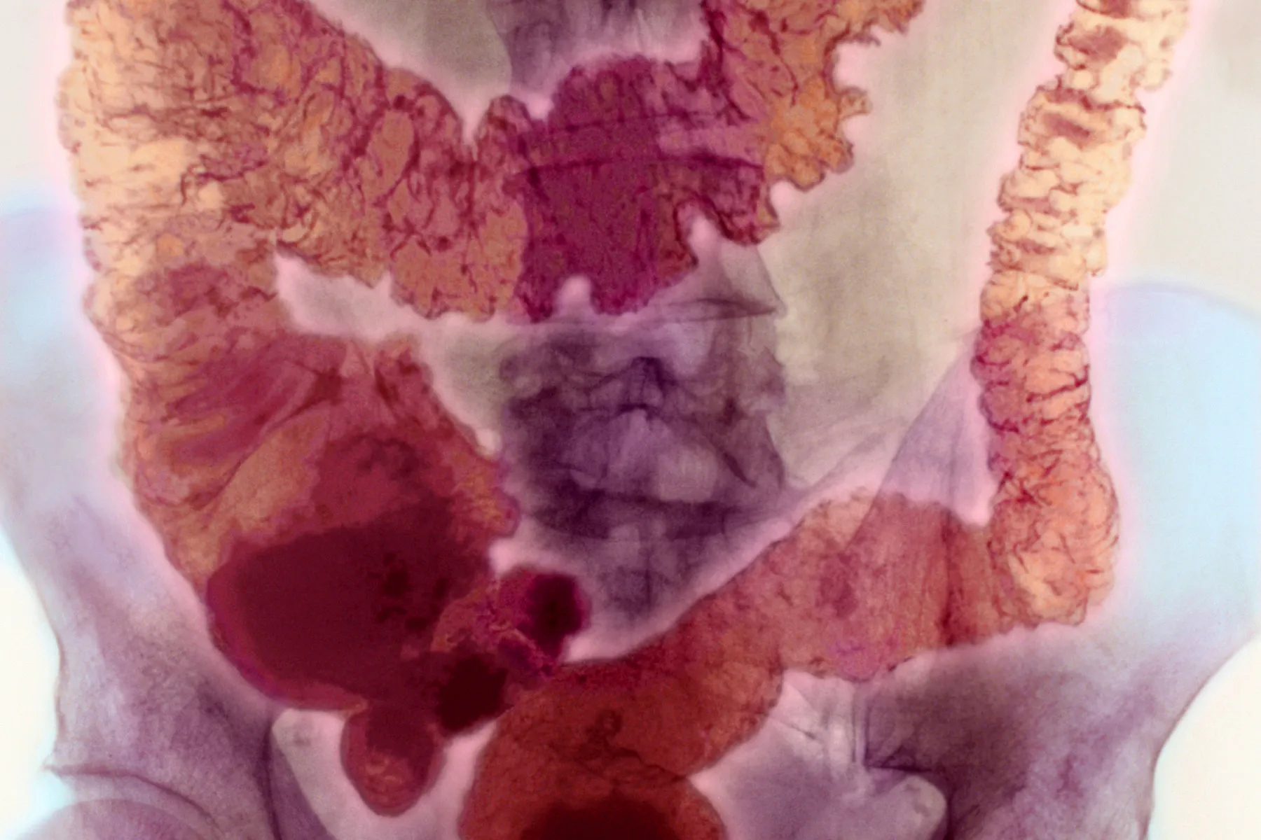 photo of ulcerative colitis anatomy