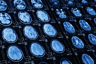 photo of brain scan of stroke