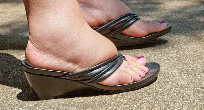 swollen feet in sandals