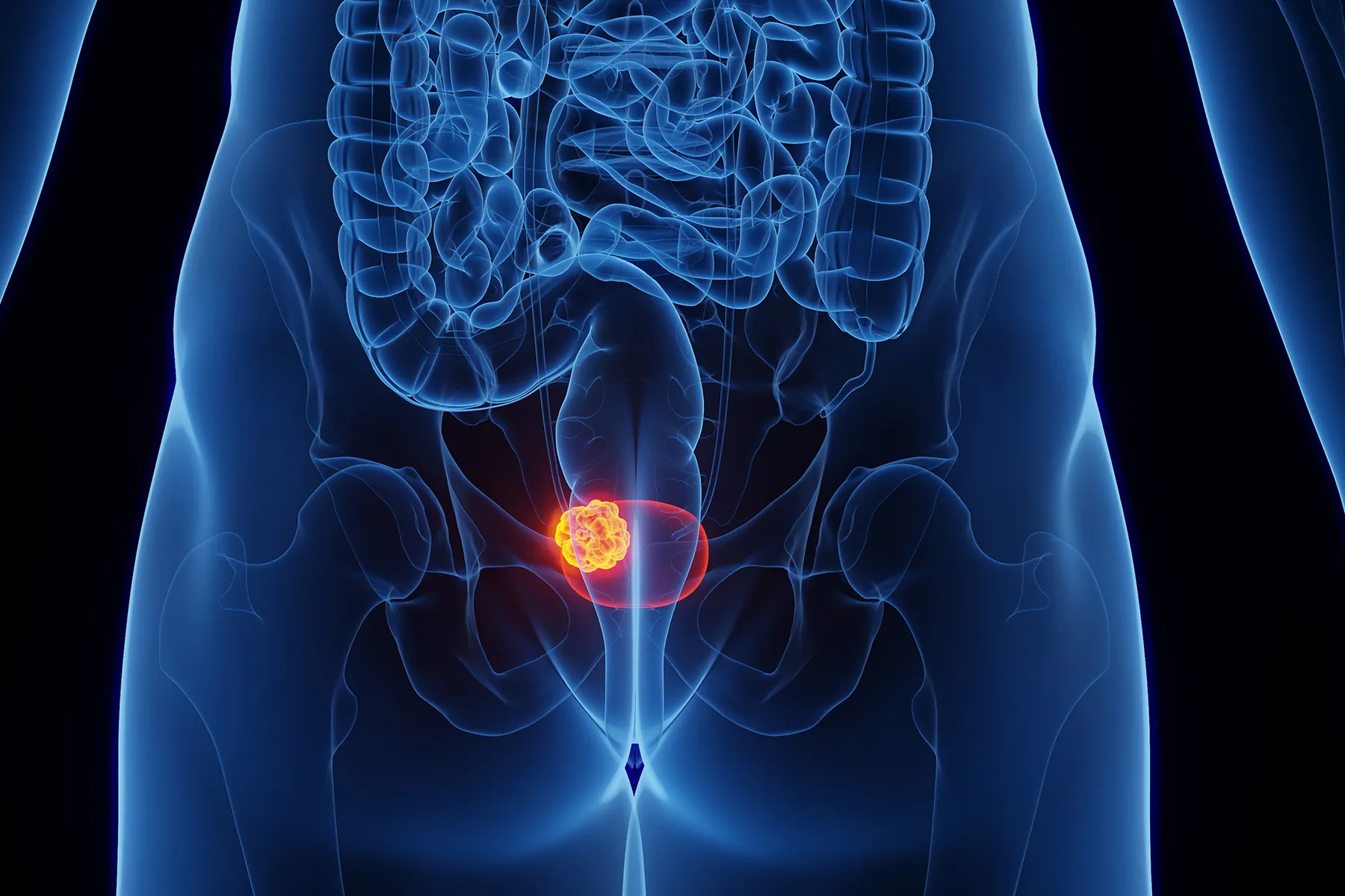 Bladder Adenocarcinoma: What to Know