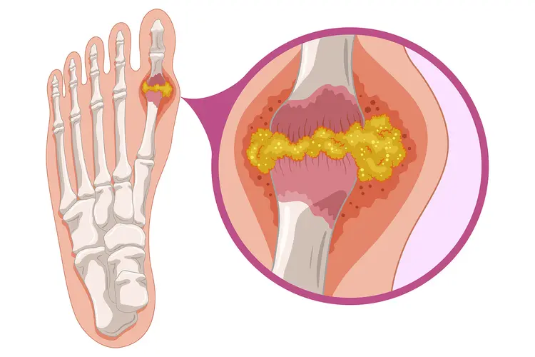 illustration of gout