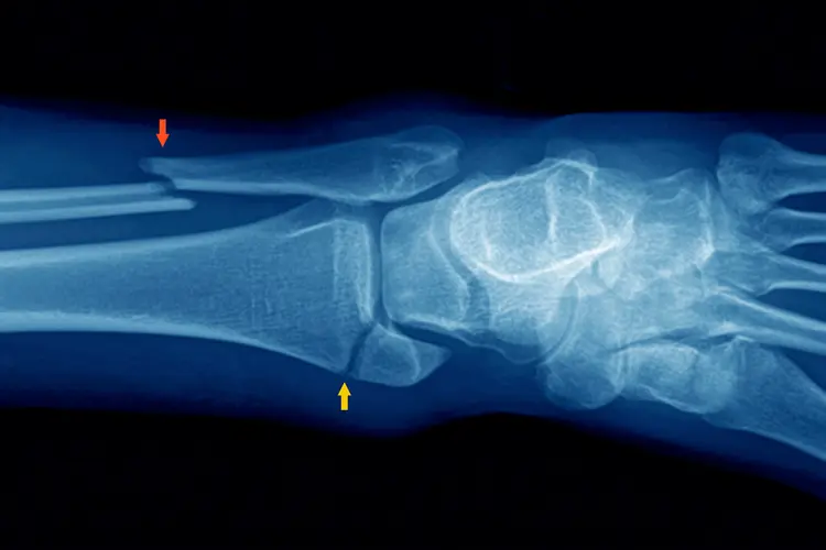 X-ray of a broken ankle