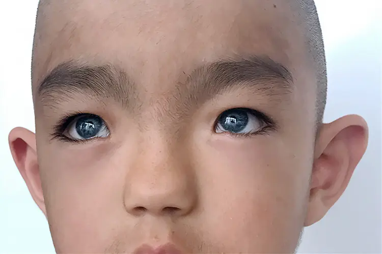 photo of child with waardenburg syndrome