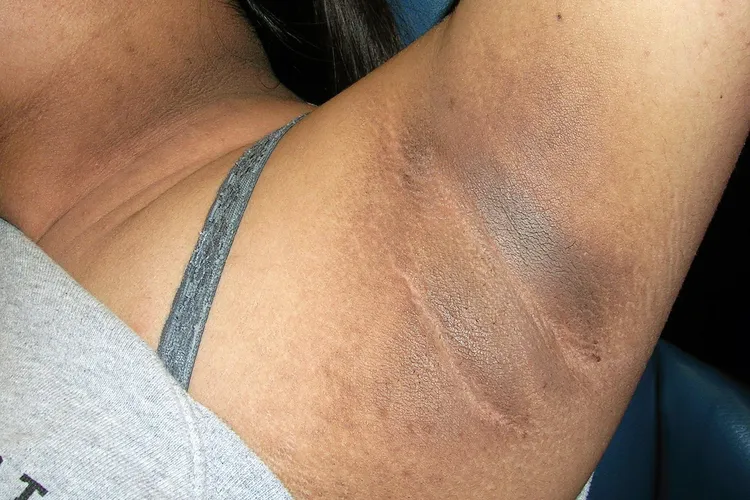 photo of acanthosis nigricans under woman's arm