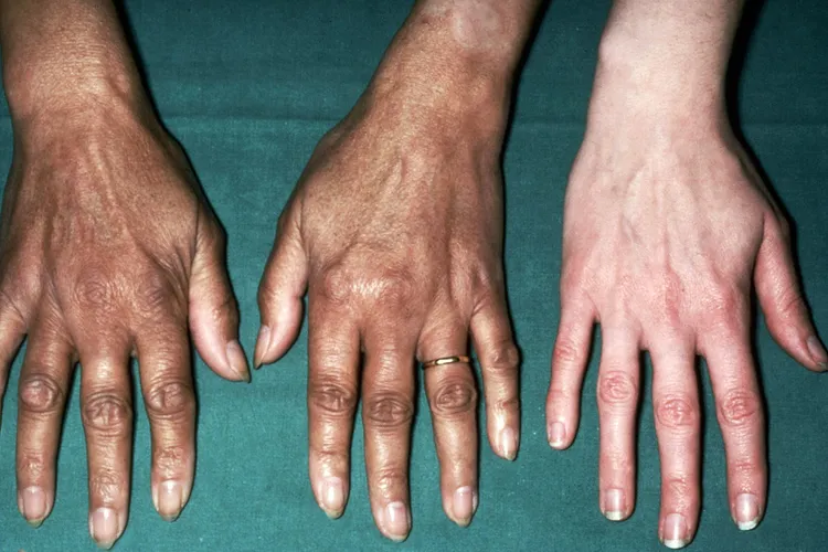 photo of  addison’s disease on woman's hands