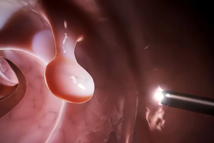 illustration of colonoscopy