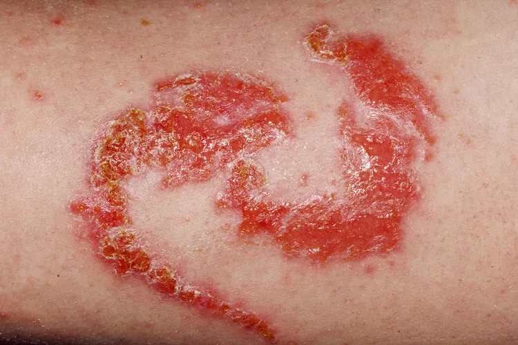 photo of allergic contact dermatitis on arm