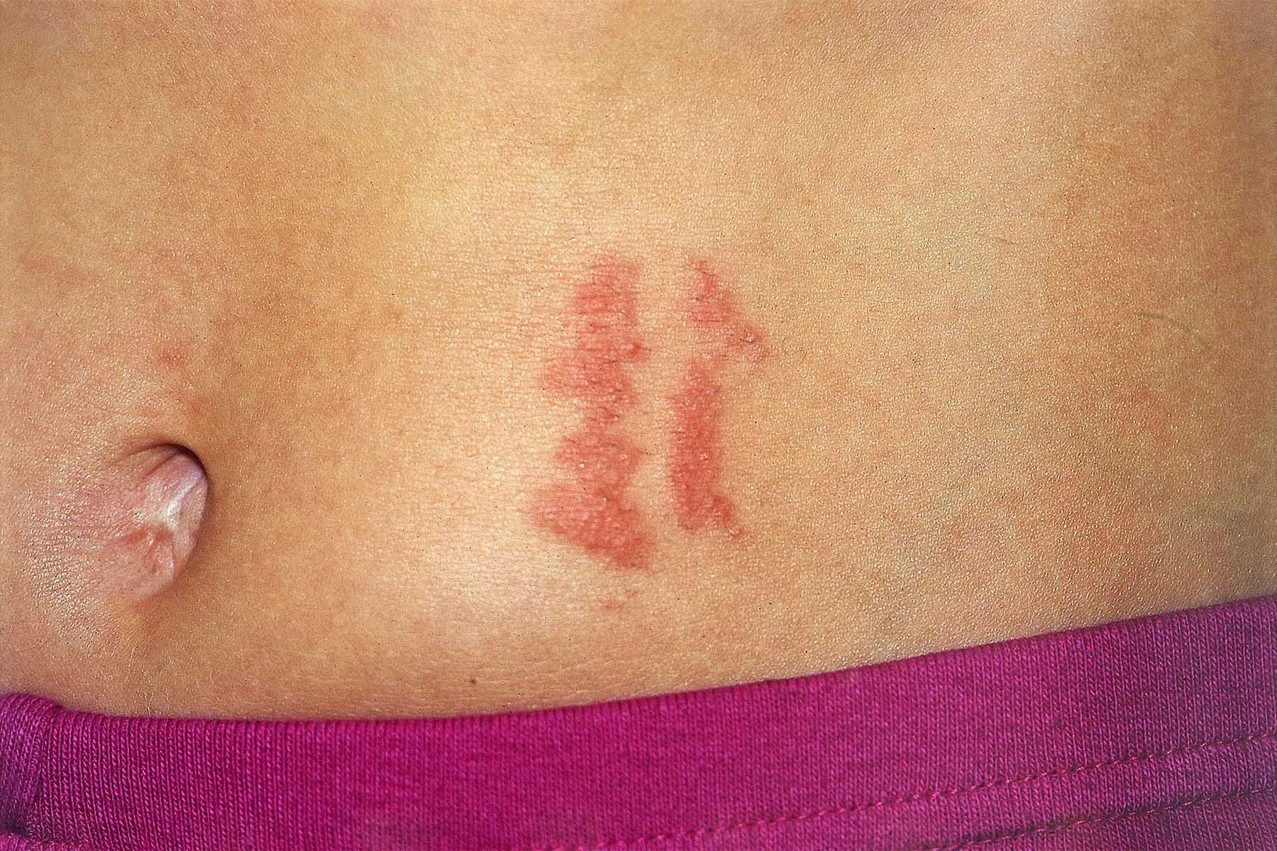 photo of Allergic Contact Dermatitis