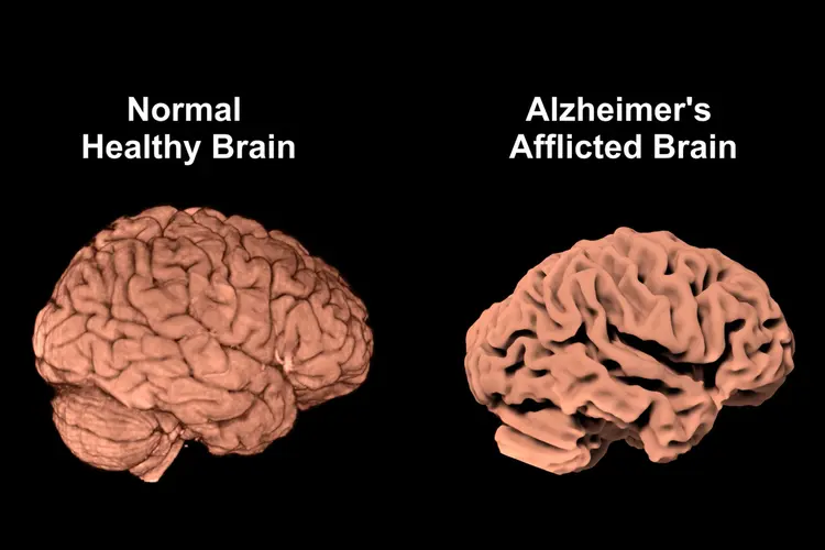 photo of alzheimer's brain