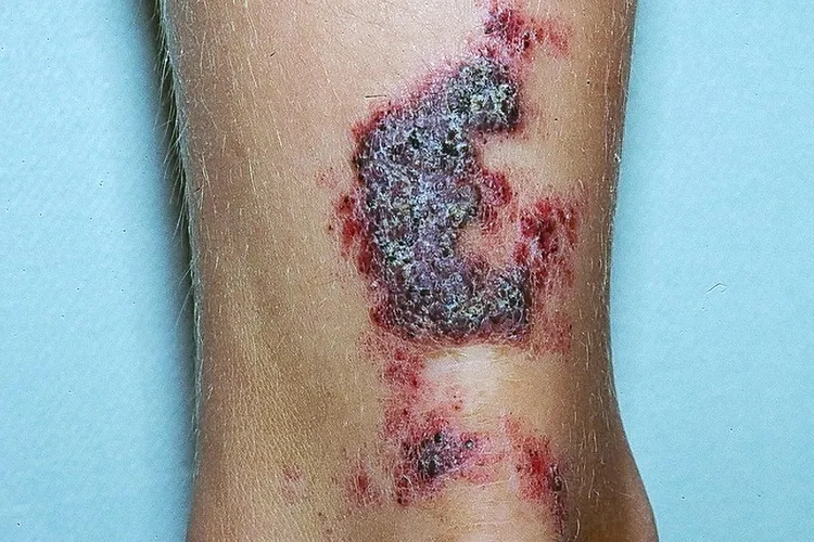 photo of angiokeratoma circumscriptum on leg