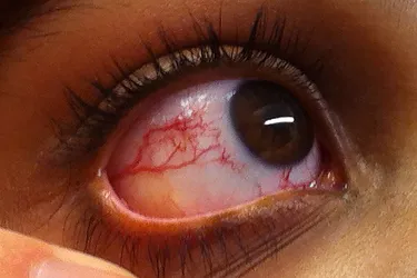 Ataxia-telangiectasia (A-T) is rare genetic disease that affects the nervous system, the immune system, and many other parts of the body. It's often characterized by clusters of dilated blood vessels in your eye. (Photo Credit: Thomas O. Crawford?/ Wikimedia Commons)