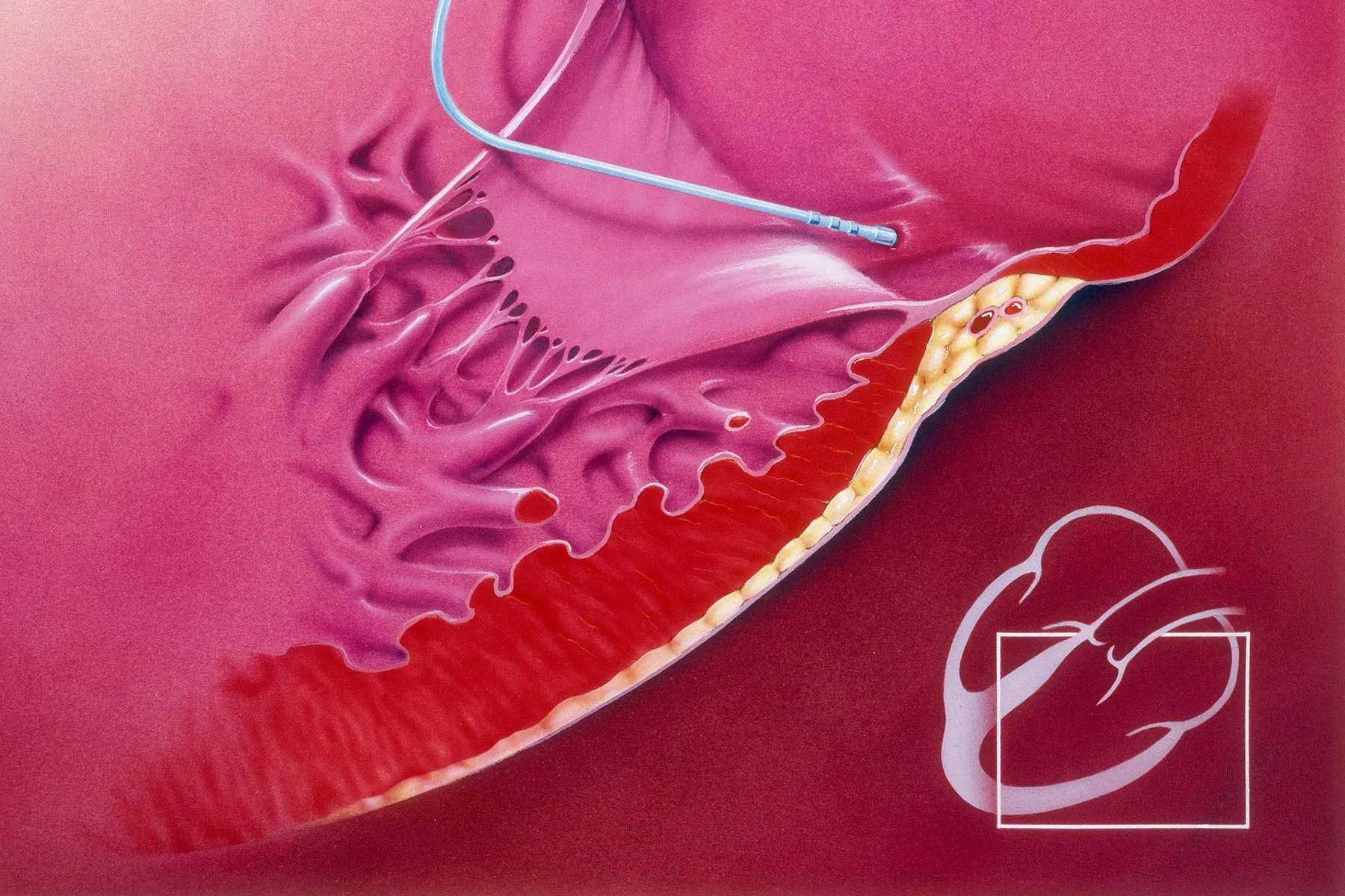 photo of radiofrequency ablation of heart