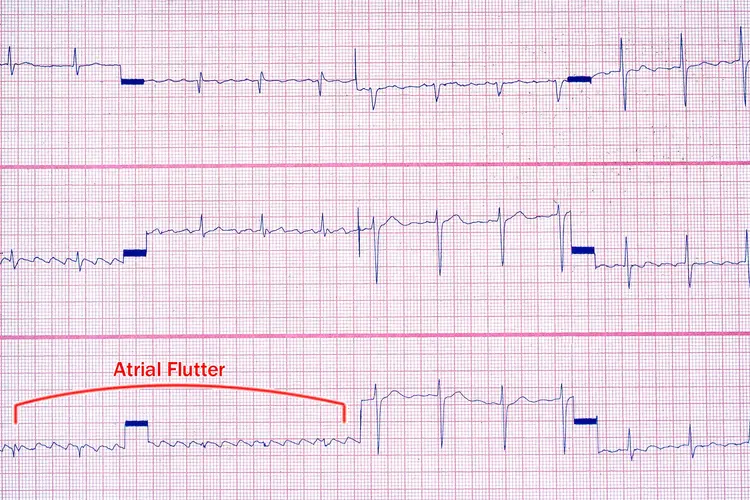 photo of atrial flutter