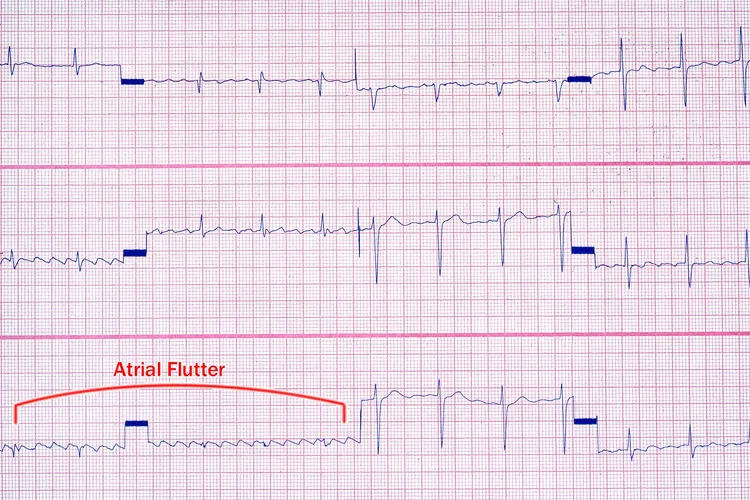 photo of atrial flutter