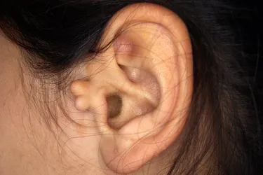 Auricular tags are small tags or nodules on the outside of the ear.