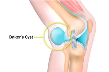  A Baker's cyst forms when your body makes too much of the fluid that keeps your knee joint moving smoothly. Photo Credit: ttsz / Getty Images 