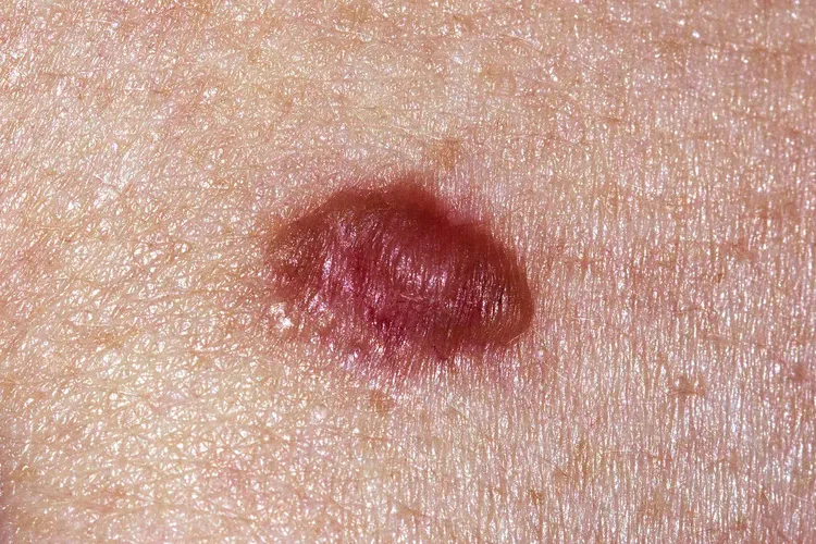 photo of Basal cell carcinoma