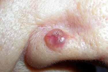 Basal cell carcinoma usually starts as a smooth tumor with tiny blood vessels, often on your nose. It can show up differently on different skin colors. It's the least risky form of skin cancer, but treatment is important to stop it from spreading. (Photo credit: Richard Usatine, MD)