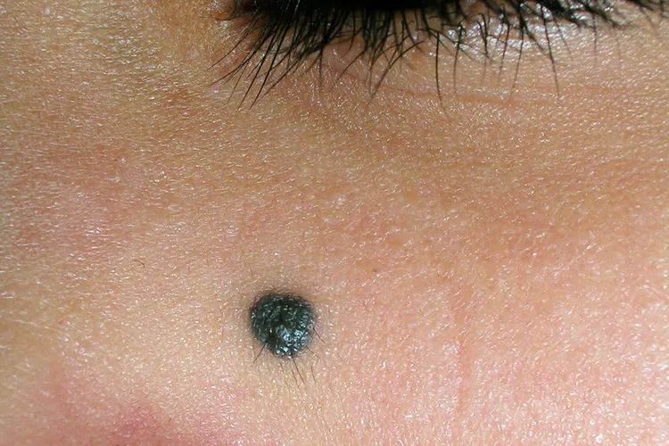 photo of blue nevus on woman's face