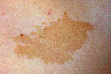 A cafe au lait macule is a harmless birthmark that appears at birth or soon after. Photo courtesy DermNet NZ