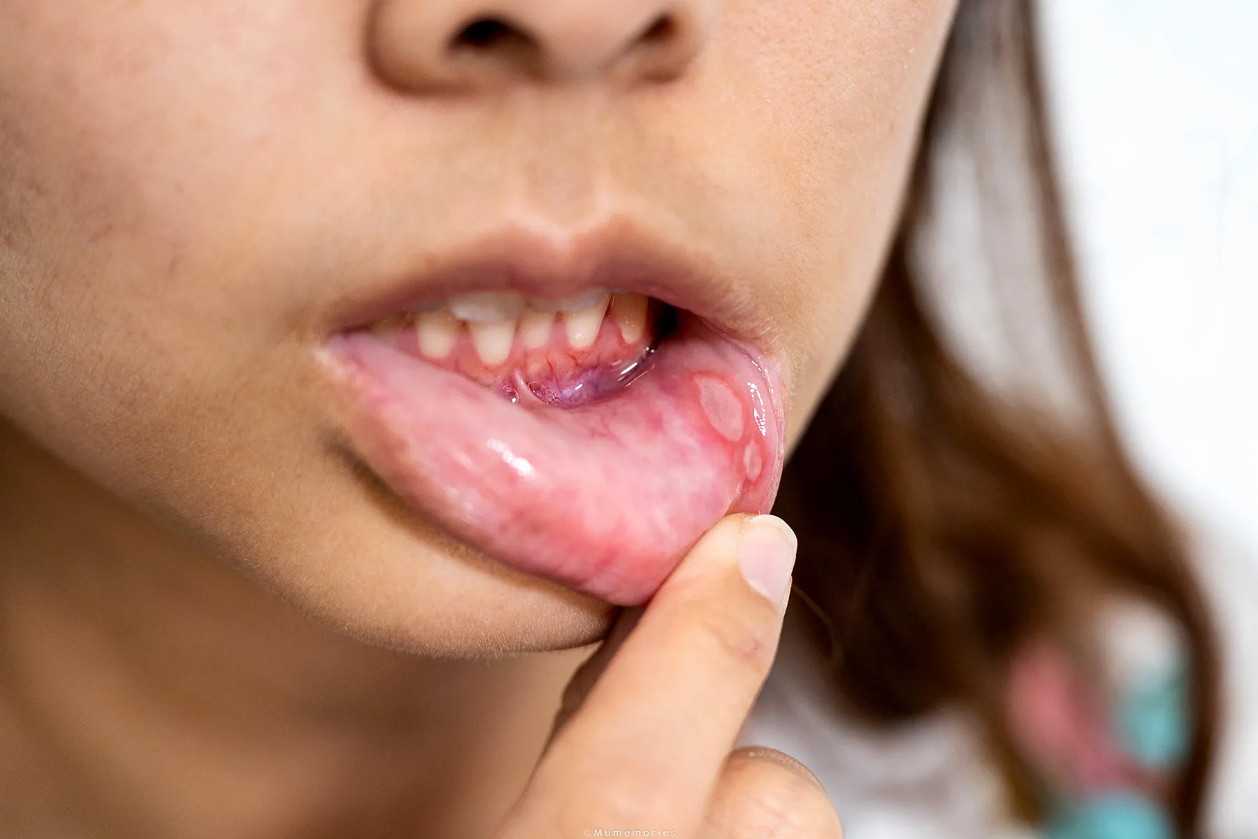 photo of woman with canker sores