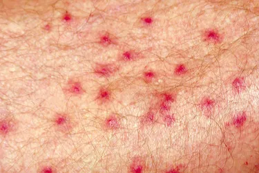 Cercarial dermatitis -- also known as swimmer's itch -- is an itchy rash caused by a small parasitic worm. You can get it by swimming or wading in infested freshwater lakes or ponds. (Photo Credit: Science Source)