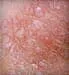 Skin Chafing Causes, Treatments, Prevention