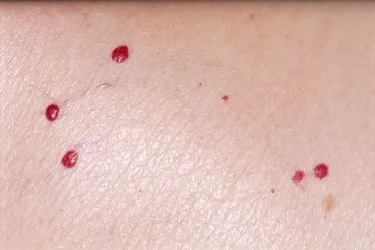 Cherry angiomas are smooth, cherry-red bumps that develop on the skin, usually on the trunk of the body. They have no symptoms, and there is no known cause. They can be the size of a pinhead or up to a quarter-inch in diameter.