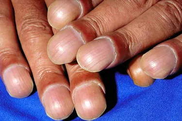Clubbed nails occur when your fingertips bulge and the nails curve down and get shiny. The condition is usually one you are born with, but you may have other health issues as well such as heart disease or lung disease. It’s unclear what causes clubbed nails, but it happens when there are certain substances in your blood such as vascular endothelial growth factor (VEGF). Your body produces more VEGF when it can't get enough oxygen.