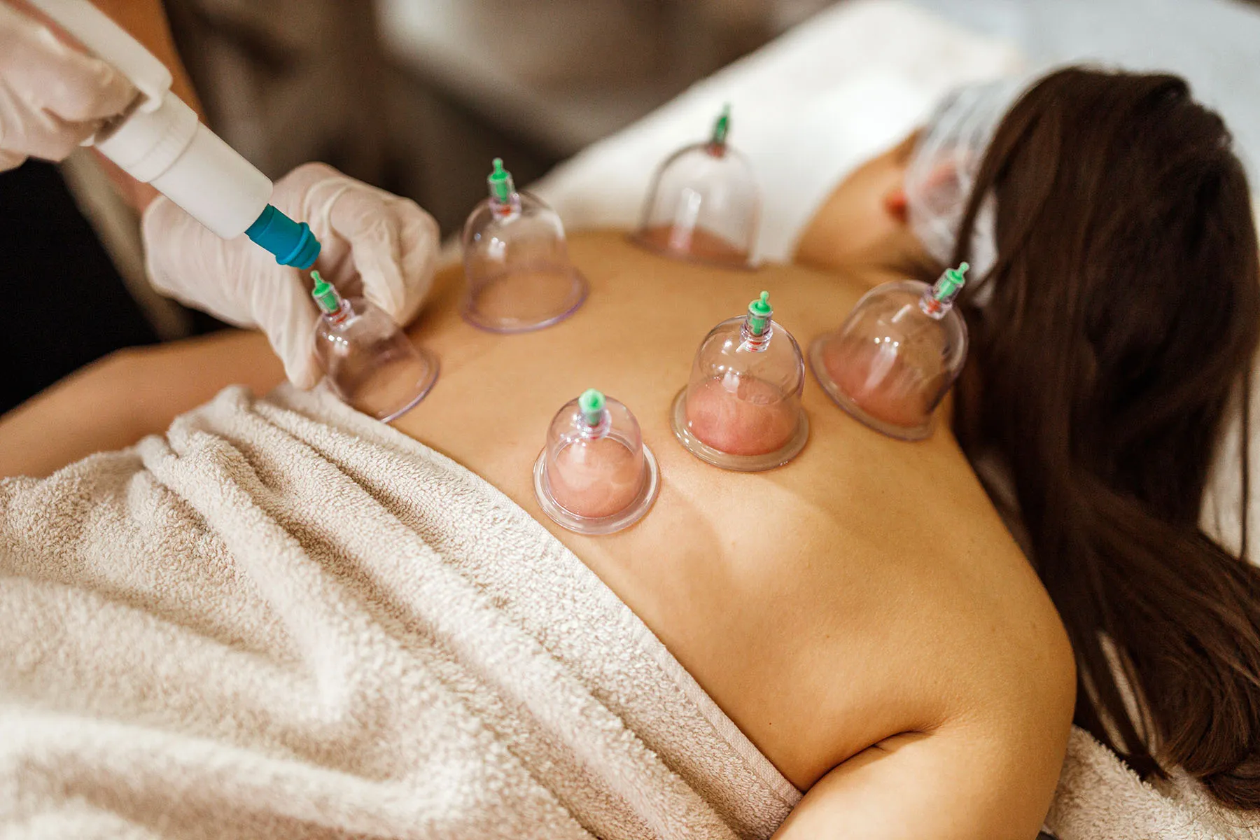 photo of woman getting cupping therapy