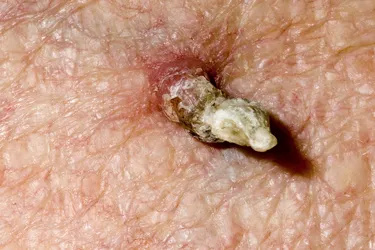 A cutaneous horn appears as a funnel-shaped growth that extends from a redbase on the skin. It is composed of compacted keratin (the same protein in fingernails). Photo Credit: Dr P. Marazzi/Science Source