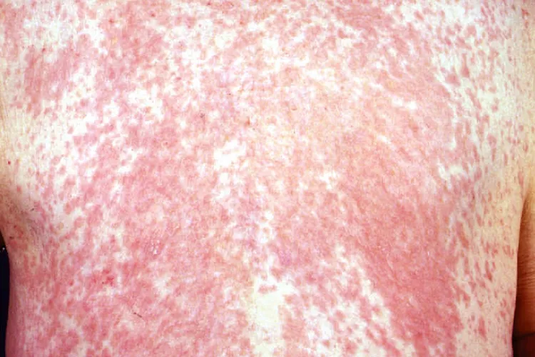photo of dermatitis medicamentosa on back