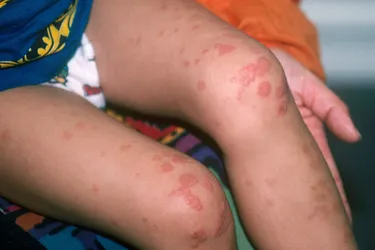 Dermatitis medicamentosa is commonly called drug eruption and is a type of skin reaction to certain medications. Its harmless but can cause red patches on the skin and even some blistering.