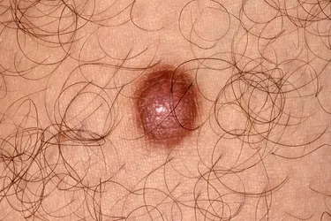 A dermatofibroma (also called benign fibrous histiocytoma) is a noncancerous fibrous nodule that can happen anywhere on the body, but is more commonly found on the arms, legs, and upper back. In most cases, dermatofibromas are small and have no symptoms. But in rare cases, skin cancers may develop within one.
